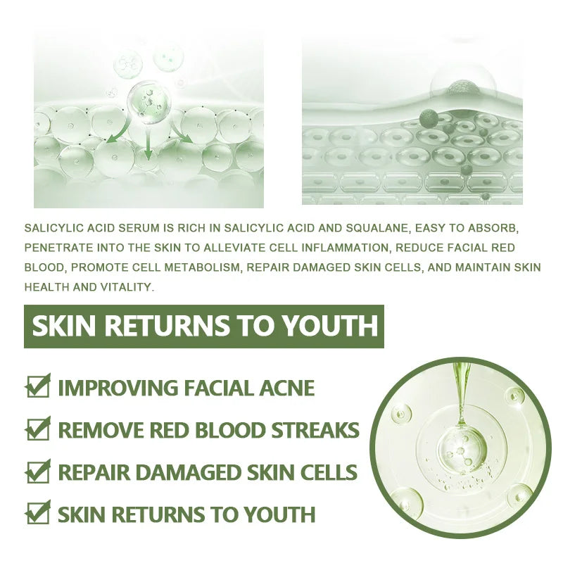 Anti-Acne Face Serum with Salicylic Acid – Acne Removing, Brightening & Moisturizing Korean Skincare with Squalane & Vitamin E |The Trendora Vault|